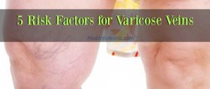 varicose veins